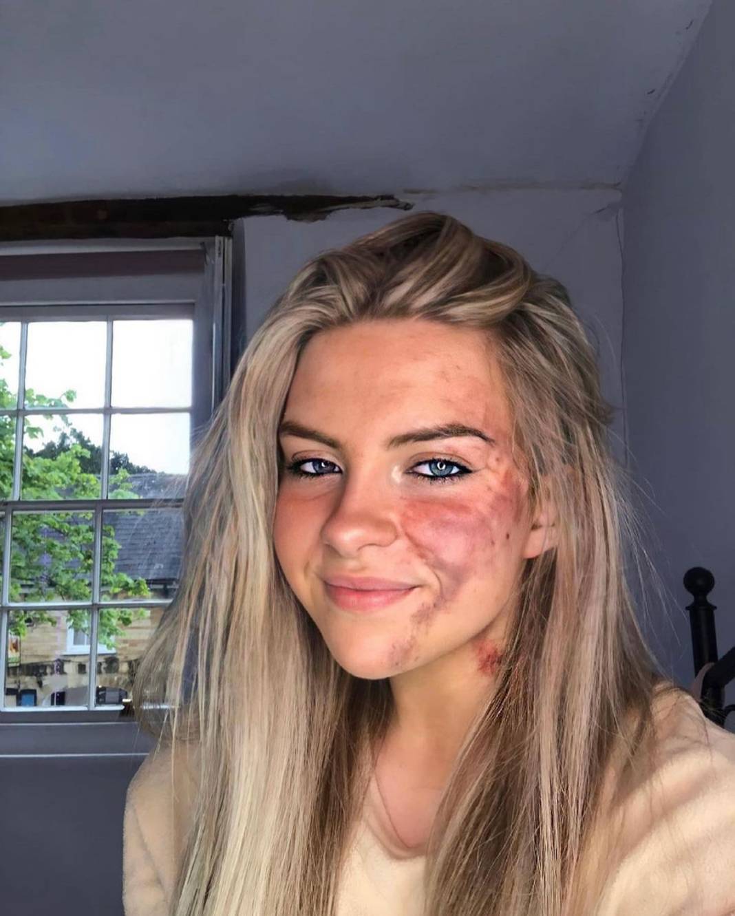 Basit bir uçuk zannetti, korkunç hastalığa yakalandı! Doktorlar bile teşhis koyamadı 7